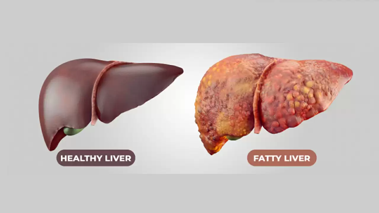 fatty liver